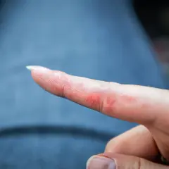 Podrażniony palec z zaczerwienieniem i suchą skórą, objawy alergii na srebro.