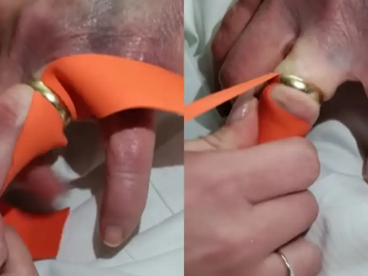 Jak bezpiecznie zdjąć obrączkę z opuchniętego palca?